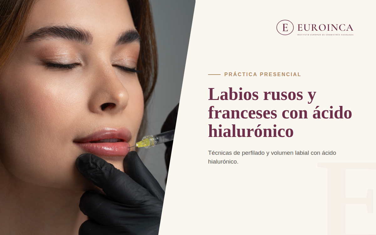 Perfilado y aumento labial con ácido hialurónico mediante técnica de labios rusos y franceses